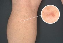 MYTH: Skin cancer only grows on sun-exposed skin